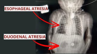 Esophageal Atresia amp Duodenal Atresia Qida borusu və Onikibarmaq bağırsaq Atreziyası [upl. by Luben]