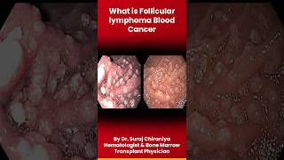 What is Follicular Lymphoma Blood Cancer by DrSurajChiraniyaHematologist lymphoma bloodcancer [upl. by Cud]