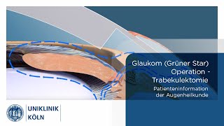 Glaukom Grüner Star OP  Trabekulektomie Patienteninformation Augenklinik  Uniklinik Köln [upl. by Adama]