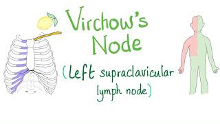 Virchows Node Left Supraclavicular Lymph Node  Cancer  Oncology [upl. by Finnie]