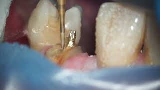 Dentatus Screw Post Removal [upl. by Scheld112]