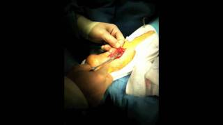 Achilles Tendon Rupture Repair Surgery  Houston Foot Surgeon [upl. by Aiciled925]