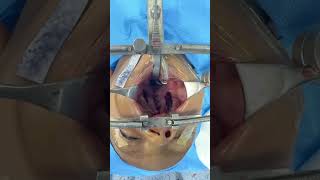 Cleft palate repair  how it looks immediately on completion [upl. by Cline]