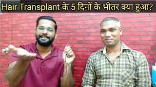 Case Study  5 Day Results After Hair Transplant Surgery  Raj Kumar With Mohit Episode02 [upl. by Caterina]