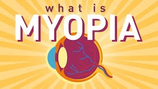 What is Myopia Short sightedness [upl. by Ancelin712]