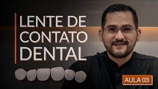 QUANTO CUSTA LENTES DE CONTATO DENTAL  AntesDepois VOU FALAR O PREÇO Vídeo COMPLETO pra DECIDIR [upl. by Ariam282]