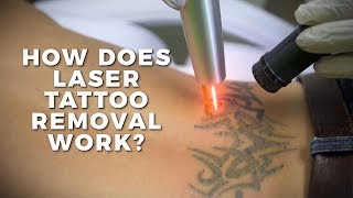 How Does Laser Tattoo Removal Work  Claudio Explains  Body Details [upl. by Esiuole]