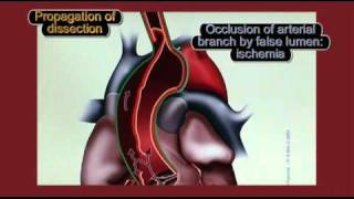 Physiopathology of aortic dissection [upl. by Rossie]