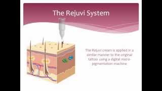 Tattoo Removal  Non laser  How it works  Rejuvi [upl. by Ahsael]