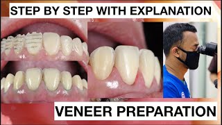 Step by Step Minimally Invasive Veneers Preparation  General Dentist Griya RR [upl. by Llewop987]