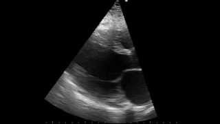 parasternal long axis echo of a patient with dilated cardiomyopathy [upl. by Coster]