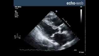 EchoWeb  Severe Aortic Stenosis with Mitral Involvement [upl. by Jose]