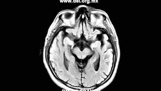 resonancia magnética de craneo resonancia magnetica craneo [upl. by Alhsa620]