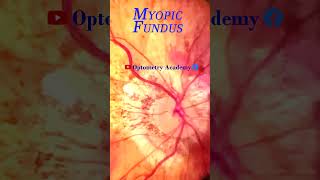 Myopic degeneration  Smartphone Fundus Videography  Fundus Photography  Short Video 63 [upl. by Morlee]