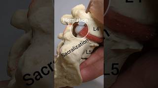 Disc Herniation Model with Lumbosacral Transitional Vertebrae [upl. by Farlie]