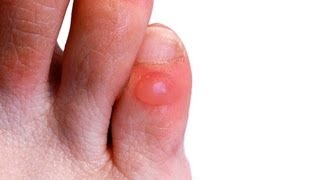 How to Prevent amp Treat Foot Blisters  Foot Care [upl. by Elladine]