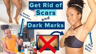 Get Rid of Hyperpigmentation Scars Dark Spots amp Boil Scars on Your Body FAST  Highly Requested [upl. by Sergu]