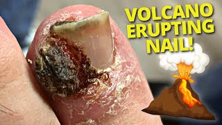 HUGE Granuloma Removal On Infected Ingrown Toenail [upl. by Onder]