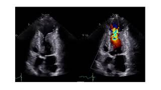 How to Assess the Level of Obstruction with Echocardiography in Patients with HCM [upl. by Dunaville]