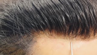 Natural Looking Frontline lace Hair Patch  Frontlace Non surgical hair replacement for men in delhi [upl. by Sigismund]