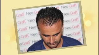 Best Hair Transplant Punjab  Best Results hair transplant Ludhiana Hair Transplant jallandhar [upl. by Nnylanna]