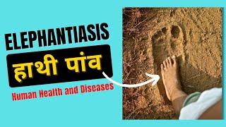 Elephantiasis Symptoms  Filariasis Class 12  Human Health and Diseases [upl. by Ahsema]