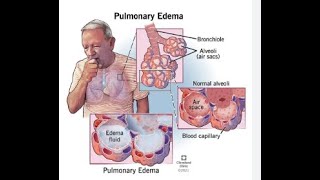 Pulmonary EdemaCardiogenic Pulmonary edemaNonCardiogenic Pulmonary edemaRespitory Therapist [upl. by Eberta]