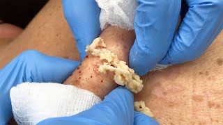 Stubborn Sac and Cyst Removal  CONTOUR DERMATOLOGY [upl. by Daphene]