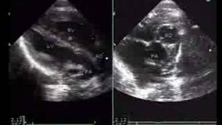 LTGA  congenitally corrected transposition of the great vessels [upl. by Ecirtemed]