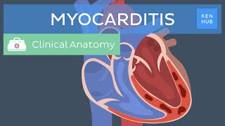 Myocarditis Causes symptoms diagnosis treatment and prognosis  Kenhub [upl. by Eyeleen]