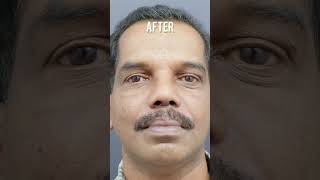 Rhinoplasty  Broad Nose Surgery  Best Nose Surgeon in Kerala  Dr Mathew PC shorts [upl. by Lizzy744]