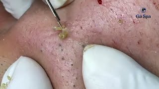 Popping Huge Blackheads and Giant Pimples  Best Pimple Popping 2024 [upl. by Anitnatsnoc]