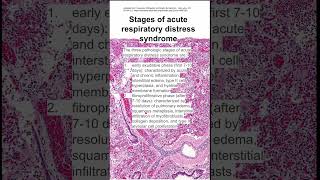 Stages of acute respiratory distress syndrome [upl. by Aritak429]