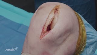 Treatment of a Medial Femoral Condyle Osteochondral Defect Using an Osteochondral Allograft [upl. by Ireland]