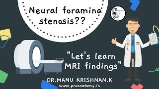 What is quotNeural Foramina StenosisNeural foramina narrowingquot amp spinal nerve root compression [upl. by Eolcin]