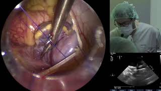 Totally Endoscopic Aortic Valve Replacement [upl. by Salot]