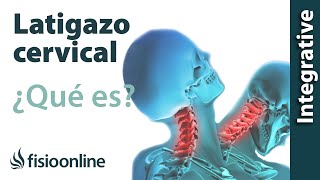 Latigazo cervical  ¿Qué es y cuáles son las claves de su solución [upl. by Ahsied]