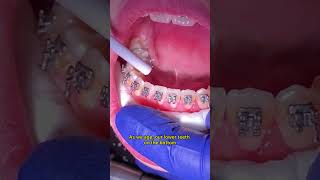 What is a permanent retainer in braces Toothtime New Braunfels Dentist  Braces journey [upl. by Fuld]