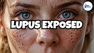 The Shocking Truth About Lupus Revealed [upl. by Thorny]