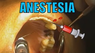 ANESTESIA DENTAL HD [upl. by Baskett]