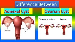 Difference Between Adnexal Cyst and Ovarian Cyst [upl. by Langsdon]