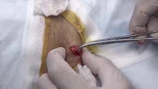 Large Epidermoid Cyst Removal Cysts Whiteheads Dermatolgy Videos [upl. by Anisirhc]