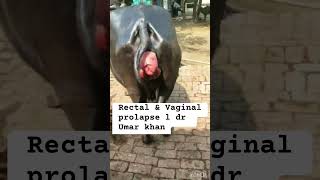 Rectal amp Vaginal prolapse l dr Umar khan [upl. by Strep]