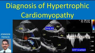 Diagnosis of Hypertrophic Cardiomyopathy [upl. by Aihgn]