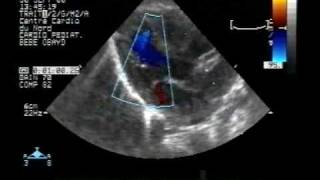 echocardiogramtransposition of the great arteries22 vsd asd pda [upl. by Dunson]