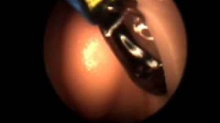 Balloon Sinuplasty for Chronic Sinusitis [upl. by Dodds734]