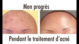 ce que j’ai fais pour nettoyé l’acne Sur mon visage Part 3 [upl. by Clementine]