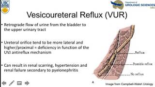 Vesicoureteral Reflux An Update [upl. by Ahse337]