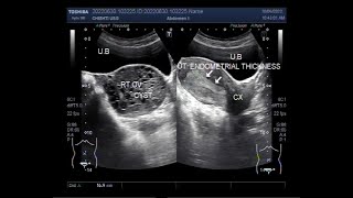 Endometrial Hyperplasia and Hemorrhagic Ovarian Cyst [upl. by Dicks328]