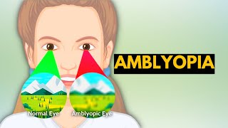 Amblyopia Causes Signs and Symptoms Diagnosis and Treatment [upl. by Savil808]